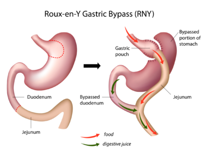 gastric bypass diagram, roux-en-y
