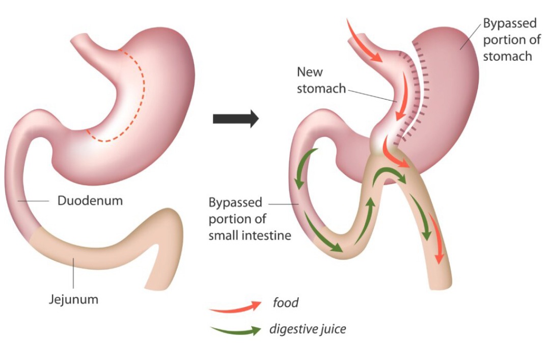 Illustration showing what happens to your stomach when having a mini gastric bypass