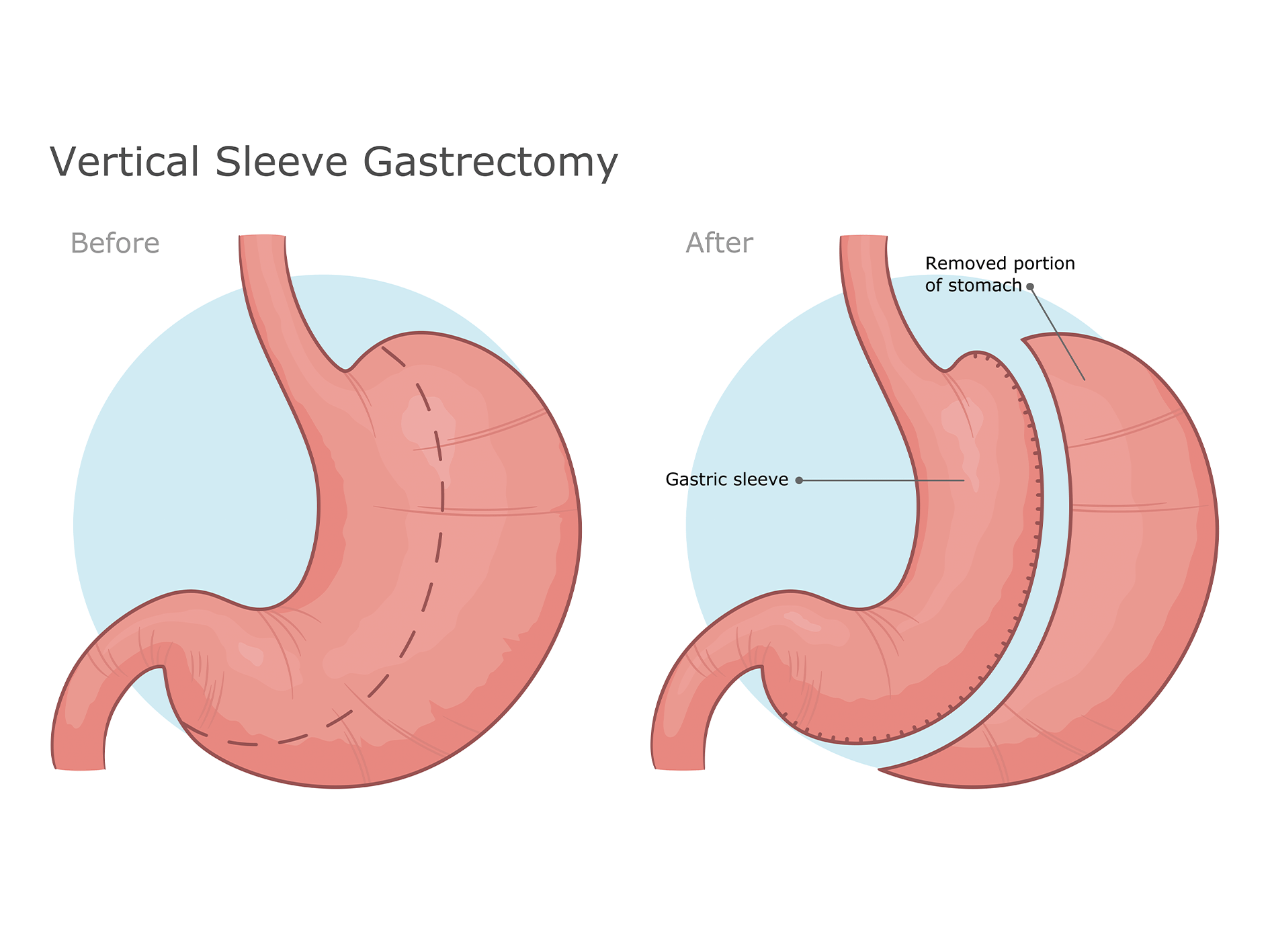 Illustration of how a stomach works before and after a gastric sleeve