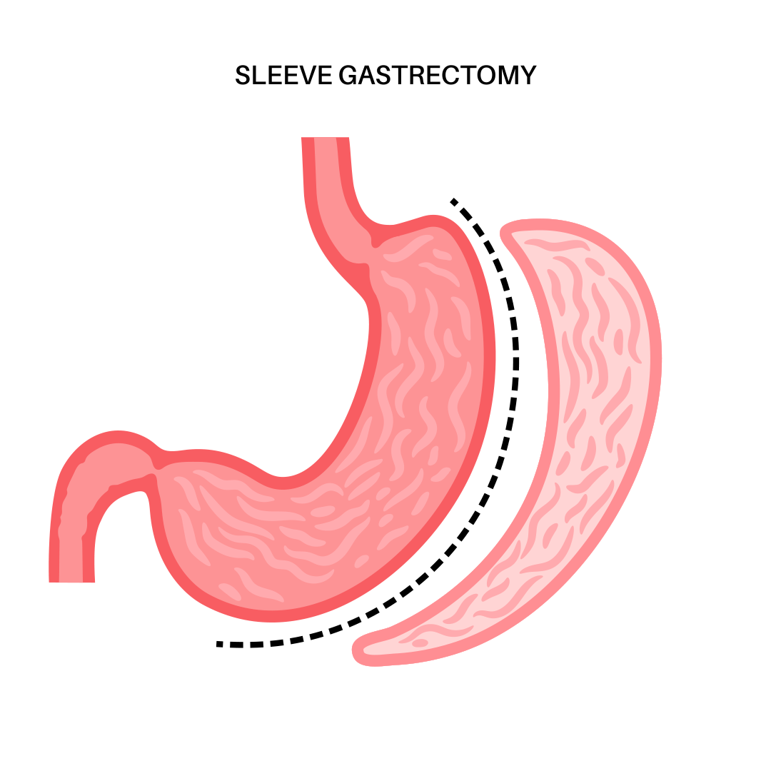 Illustration of a stomach after a gastric sleeve